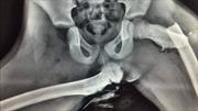 Esta radiografía muestra las terribles consecuencias de viajar con los pies en el tablero